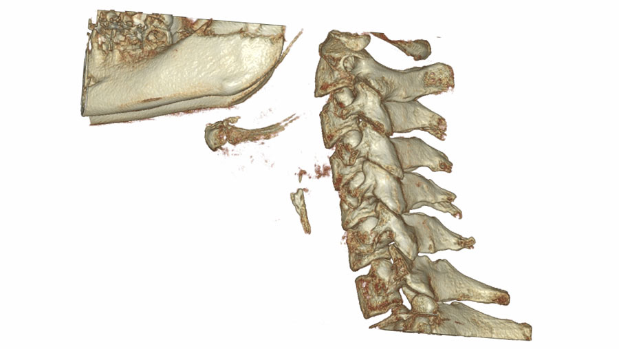 Kręgi szyjne C1, C2, C3