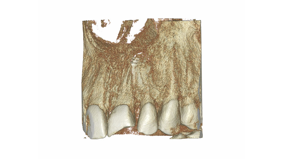 Okolice zęba (endo)