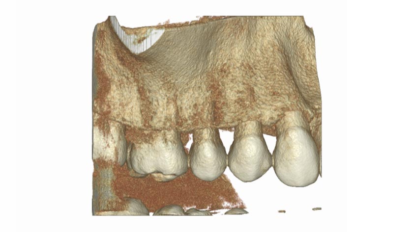 Okolice zęba (standard)