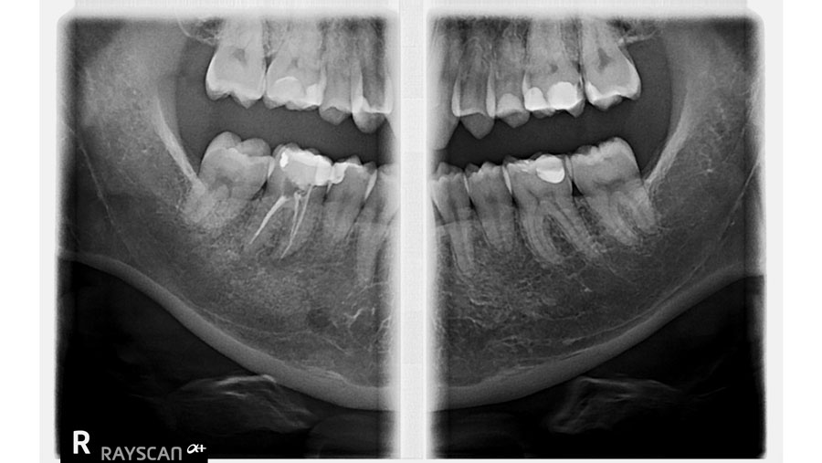 Skrzydłowo-zgryzowe P i L