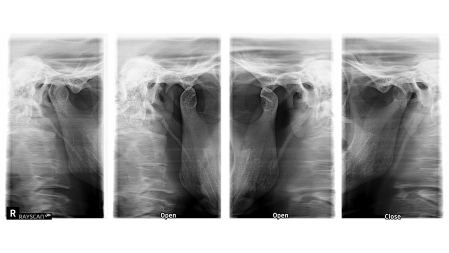 SSŻ zwarte i rozwarte