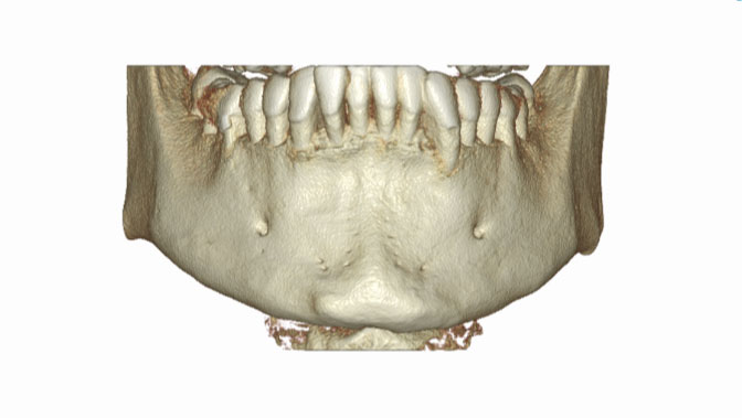 Szczęka lub żuchwa