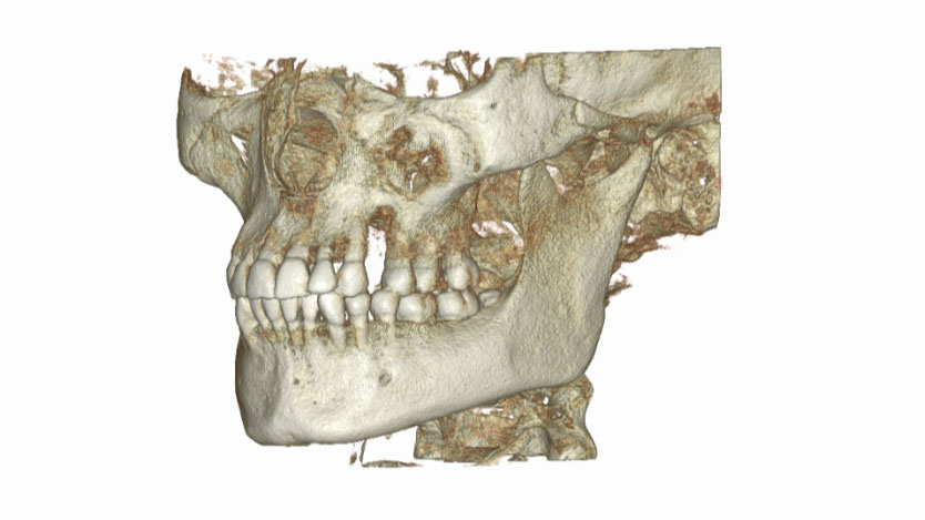 Szczęka, żuchwa, SSŻ