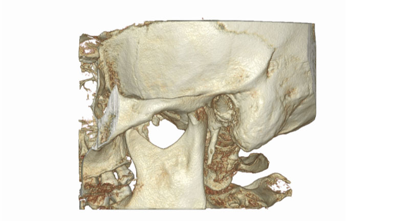 Ucho środkowe L lub P