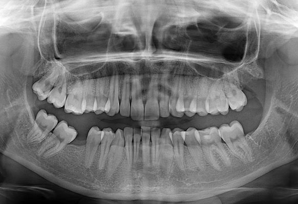 Zdjęcia pantomograficzne Poznań – dlaczego ESDENT?