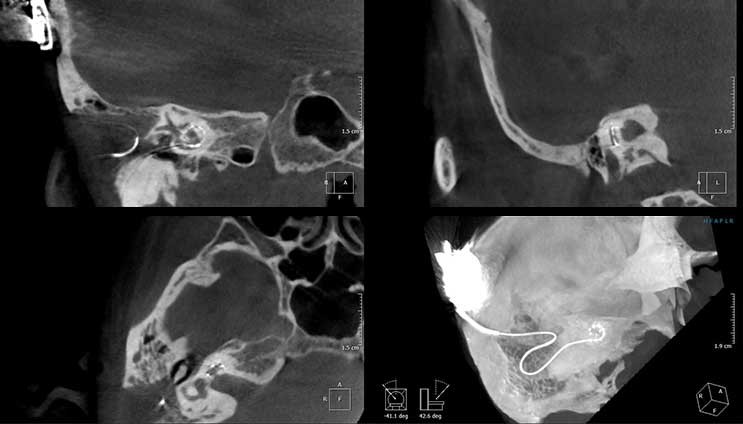 Tomografia ucha - Implant Słuchowy