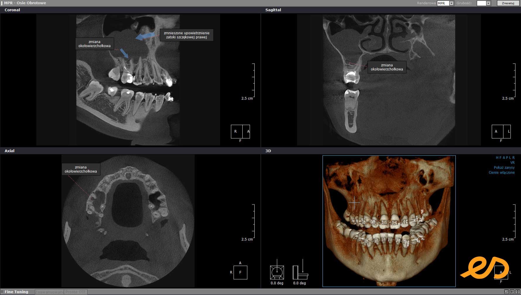 badanie tomograficzme cbct stan zapalny zatoki 1744197277
