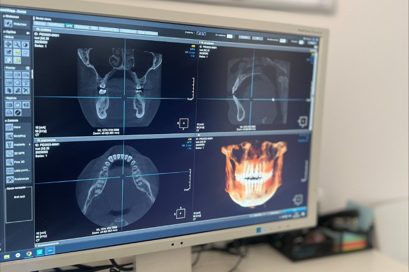 Tomografia CBCT w pracowni ESDENT Lubin