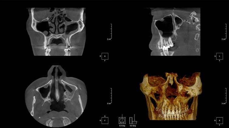 Tomografia zatok - zdjęcia