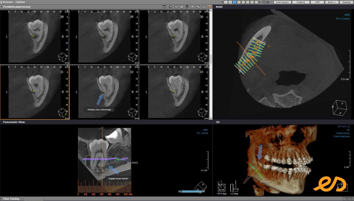 Tomografia CBCT - szczęka