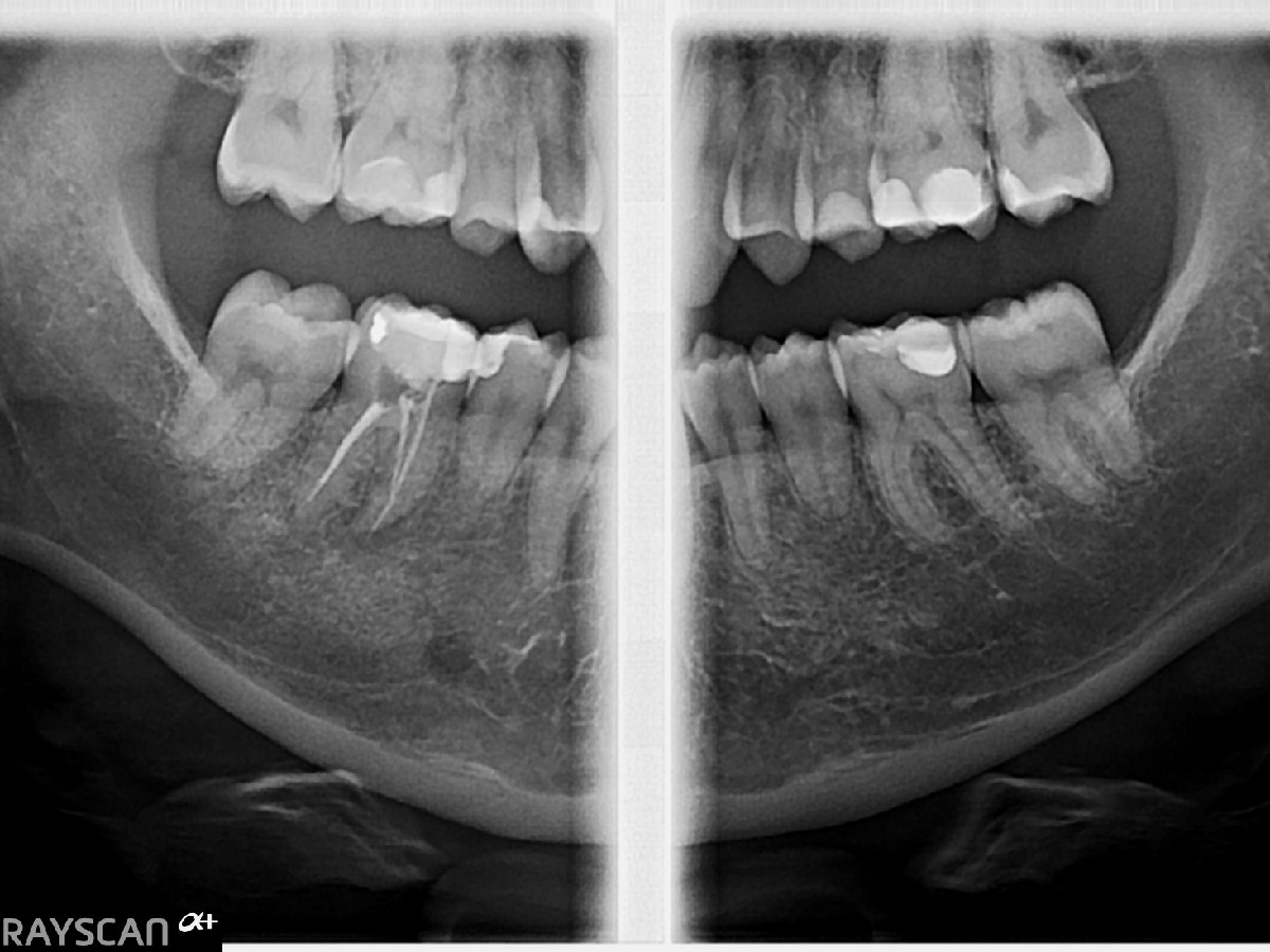 Zdjęcie - skrzydłowo-zgryzowe RTG prawe i lewe