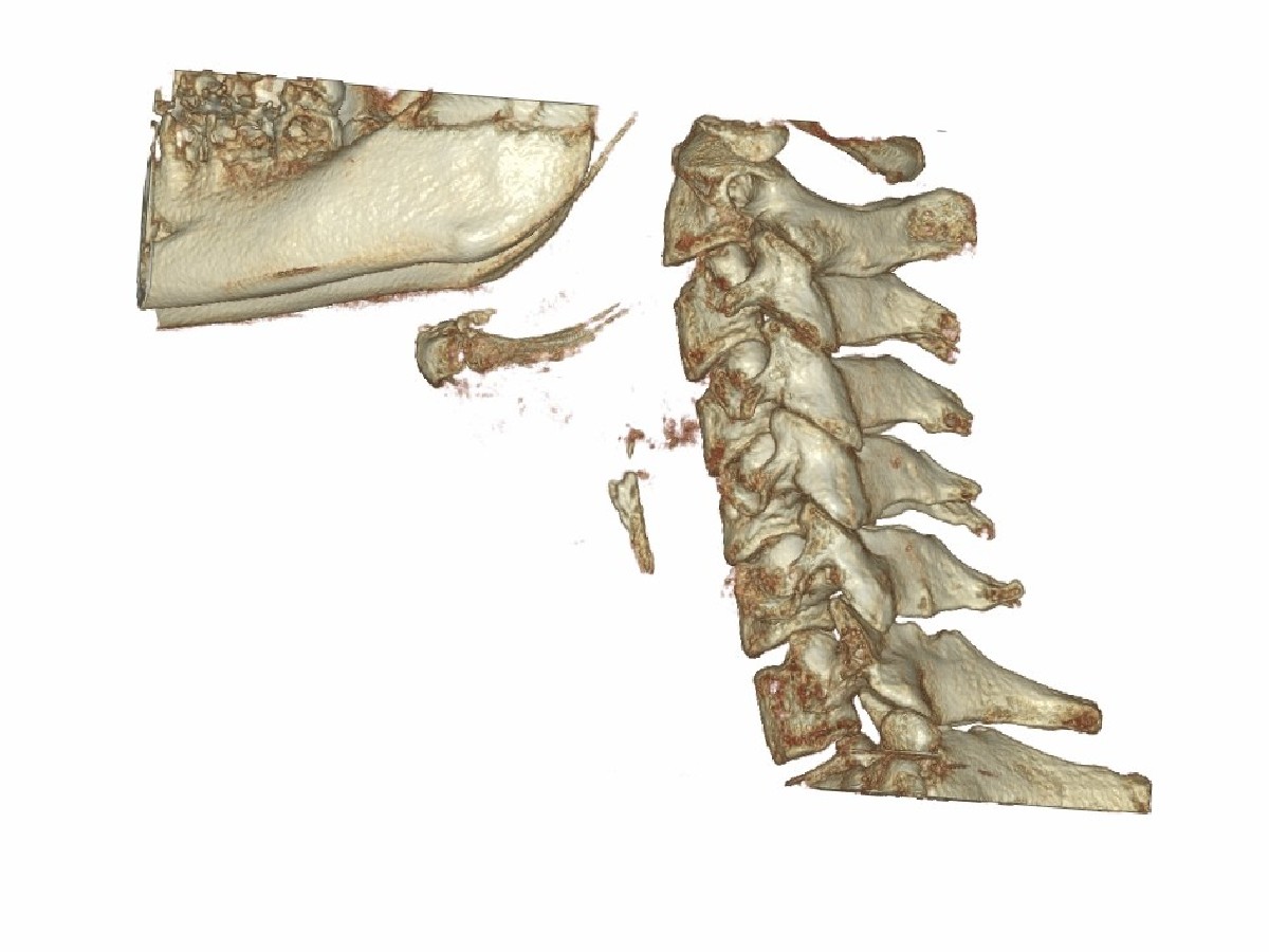 Tomografia kręgów szyjnych - zdjęcie