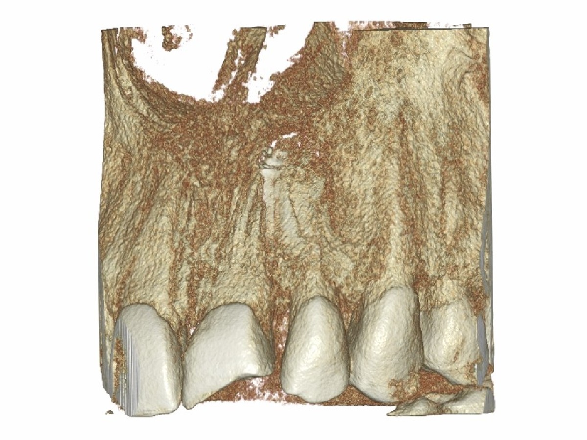 Tomografia okolic zęba - zdjęcie