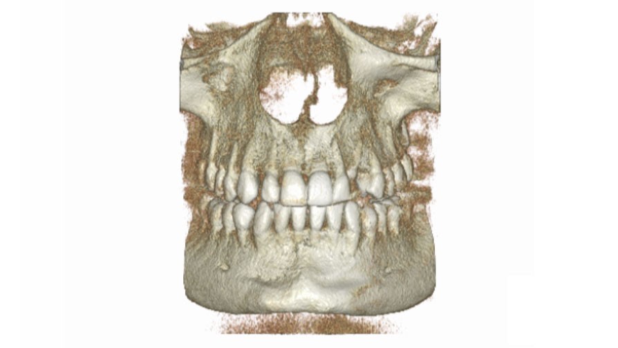 Tomografia pozabiegowa szczęki i żuchwy - zdjęcie