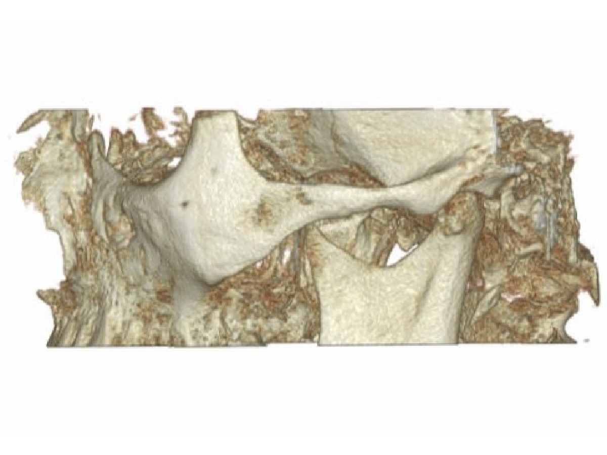 Tomografia stawów skroniowo-żuchwowych - zdjęcie