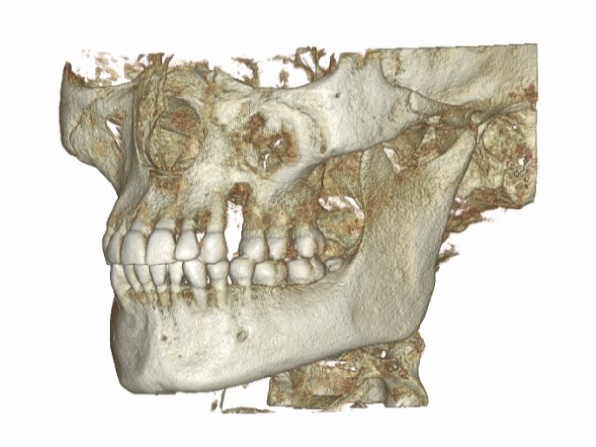 Tomografia szczęki, żuchwy i SSŻ - zdjęcie
