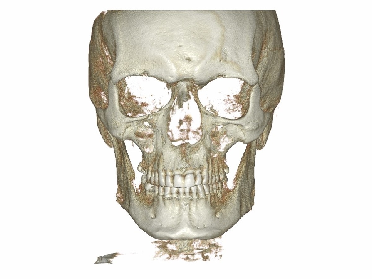 Tomografia twarzoczaszki - zdjęcie