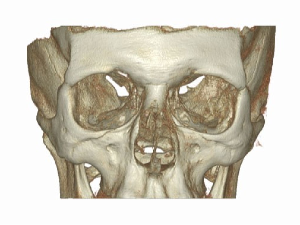 Tomografia zatok - zdjęcie